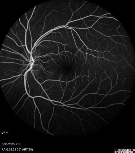 Disc drusen 8 year old boy - fluorescein shows no leakage
8 year old boy with headache and nausea.  He had a negative MRI. Images show hyper FAF from drusen and no leakage on FA.  No spinal tap was done.  VA was 20/40 both eyes.
