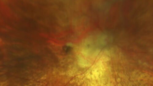 Optic Disc Melanocytoma - Atypical
45 year old female with normal vision and optic nerve lesion in the left eye.  VA 20/16 OU.  Extensive testing was normal including brain and orbit MRI.  The lesion has been stable for 5 years.
