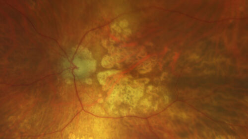 Optic Disc Melanocytoma - Atypical
45 year old female with normal vision and optic nerve lesion in the left eye.  VA 20/16 OU.  Extensive testing was normal including brain and orbit MRI.  The lesion has been stable for 5 years.
