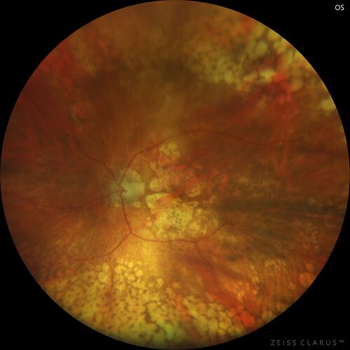 Optic Disc Melanocytoma - Atypical
45 year old female with normal vision and optic nerve lesion in the left eye.  VA 20/16 OU.  Extensive testing was normal including brain and orbit MRI.  The lesion has been stable for 5 years.
