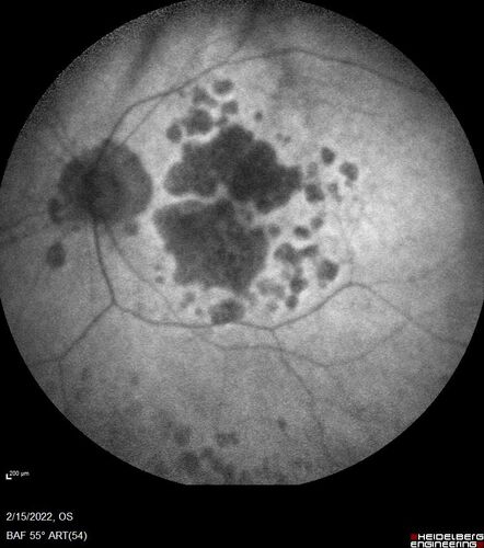Optic Disc Melanocytoma - Atypical
45 year old female with normal vision and optic nerve lesion in the left eye.  VA 20/16 OU.  Extensive testing was normal including brain and orbit MRI.  The lesion has been stable for 5 years.
