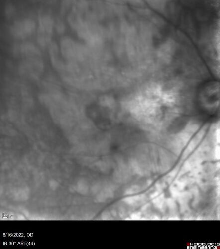 Optic Disc Melanocytoma - Atypical
45 year old female with normal vision and optic nerve lesion in the left eye.  VA 20/16 OU.  Extensive testing was normal including brain and orbit MRI.  The lesion has been stable for 5 years.
