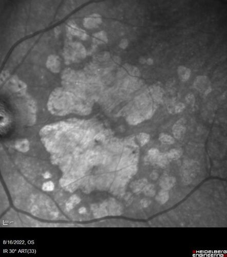 Optic Disc Melanocytoma - Atypical
45 year old female with normal vision and optic nerve lesion in the left eye.  VA 20/16 OU.  Extensive testing was normal including brain and orbit MRI.  The lesion has been stable for 5 years.
