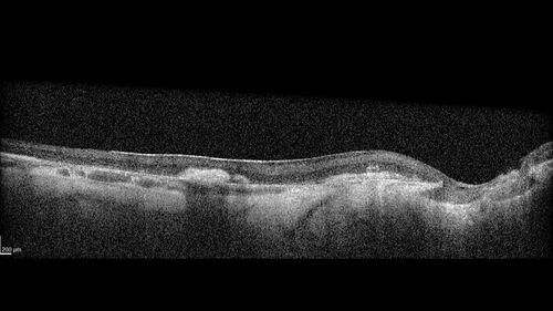 Optic Disc Melanocytoma - Atypical
45 year old female with normal vision and optic nerve lesion in the left eye.  VA 20/16 OU.  Extensive testing was normal including brain and orbit MRI.  The lesion has been stable for 5 years.
