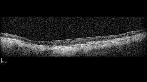 Optic Disc Melanocytoma - Atypical
45 year old female with normal vision and optic nerve lesion in the left eye.  VA 20/16 OU.  Extensive testing was normal including brain and orbit MRI.  The lesion has been stable for 5 years.
