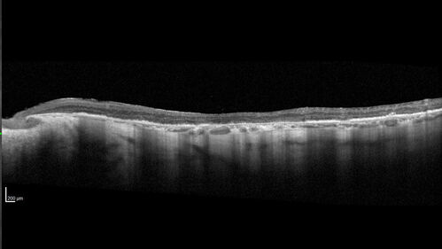 Optic Disc Melanocytoma - Atypical
45 year old female with normal vision and optic nerve lesion in the left eye.  VA 20/16 OU.  Extensive testing was normal including brain and orbit MRI.  The lesion has been stable for 5 years.
