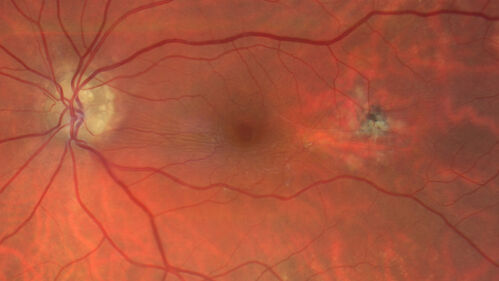 Optic Disc Drusen - Calcified
