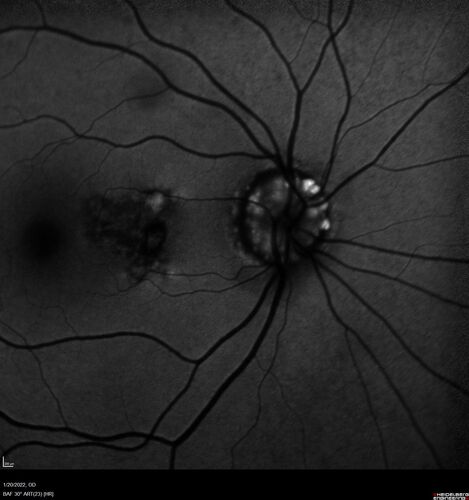 Optic Disc Drusen - Calcified
