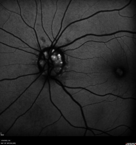 Optic Disc Drusen - Calcified
