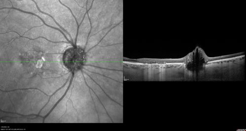 Optic Disc Drusen - Calcified
