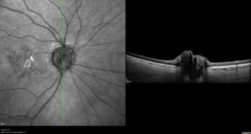 Optic Disc Drusen - Calcified
