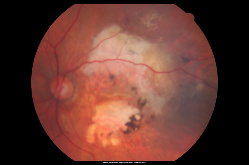 Disciform Macular Scar Both Eyes from Wet Macular Degeneration
86-year-old woman has disciform scars  OD:  20/400;  OS:   20/100
