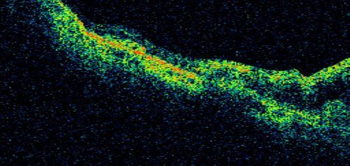 Disciform Macular Scar Both Eyes from Wet Macular Degeneration
86-year-old woman has disciform scars  OD:  20/400;  OS:   20/100
