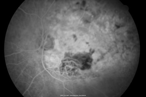 Disciform Macular Scar Both Eyes from Wet Macular Degeneration
86-year-old woman has disciform scars  OD:  20/400;  OS:   20/100

