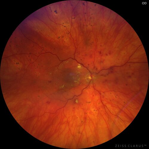 Siegrist Streaks and severe diabetic macular edema
56 year old female who presents four years after developing necrotizing fascitis and multiple organ failure from an infected foot from a roofing nail.  Her vision was 20/100 OU.  She has multiple peripheral pigment spots consistent with Siegrist streaks.
