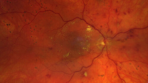 Siegrist Streaks and severe diabetic macular edema
56 year old female who presents four years after developing necrotizing fascitis and multiple organ failure from an infected foot from a roofing nail.  Her vision was 20/100 OU.  She has multiple peripheral pigment spots consistent with Siegrist streaks.
