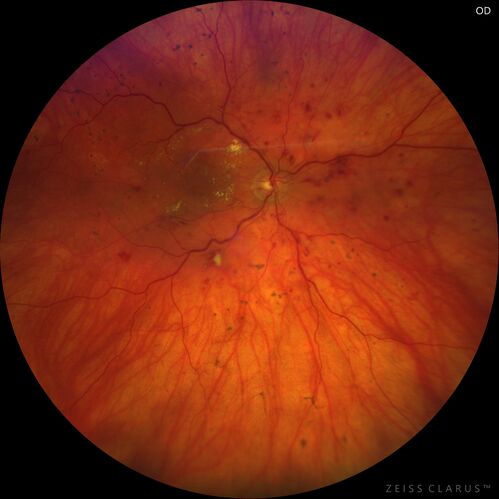 Siegrist Streaks and severe diabetic macular edema
56 year old female who presents four years after developing necrotizing fascitis and multiple organ failure from an infected foot from a roofing nail.  Her vision was 20/100 OU.  She has multiple peripheral pigment spots consistent with Siegrist streaks.
