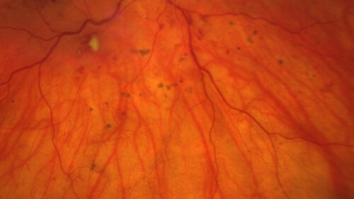 Siegrist Streaks and severe diabetic macular edema
56 year old female who presents four years after developing necrotizing fascitis and multiple organ failure from an infected foot from a roofing nail.  Her vision was 20/100 OU.  She has multiple peripheral pigment spots consistent with Siegrist streaks.
