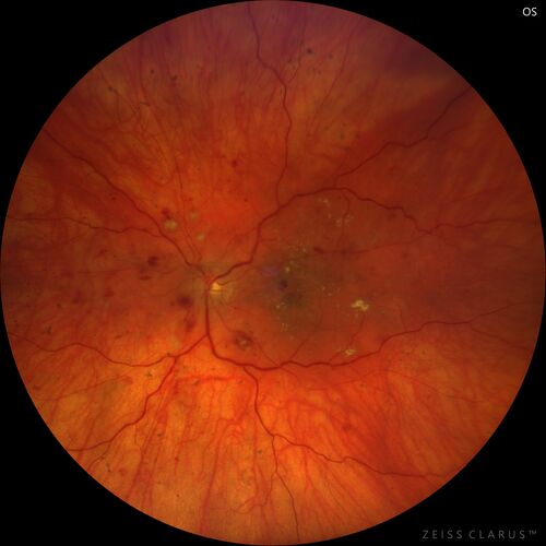 Siegrist Streaks and severe diabetic macular edema
56 year old female who presents four years after developing necrotizing fascitis and multiple organ failure from an infected foot from a roofing nail.  Her vision was 20/100 OU.  She has multiple peripheral pigment spots consistent with Siegrist streaks.
