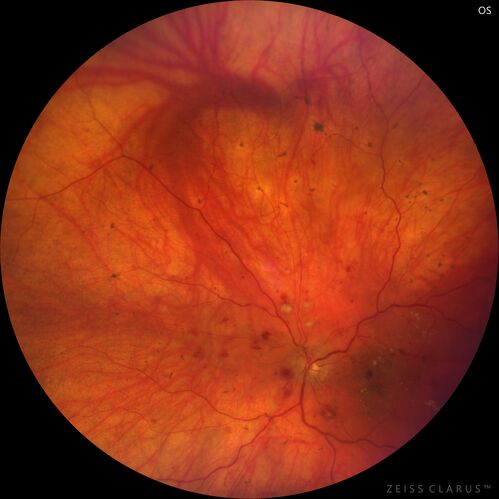 Siegrist Streaks and severe diabetic macular edema
56 year old female who presents four years after developing necrotizing fascitis and multiple organ failure from an infected foot from a roofing nail.  Her vision was 20/100 OU.  She has multiple peripheral pigment spots consistent with Siegrist streaks.
