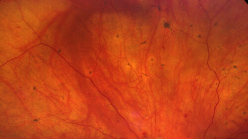 Siegrist Streaks and severe diabetic macular edema
56 year old female who presents four years after developing necrotizing fascitis and multiple organ failure from an infected foot from a roofing nail.  Her vision was 20/100 OU.  She has multiple peripheral pigment spots consistent with Siegrist streaks.
