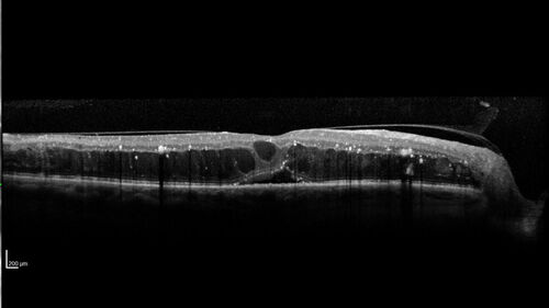 Siegrist Streaks and severe diabetic macular edema
56 year old female who presents four years after developing necrotizing fascitis and multiple organ failure from an infected foot from a roofing nail.  Her vision was 20/100 OU.  She has multiple peripheral pigment spots consistent with Siegrist streaks.
