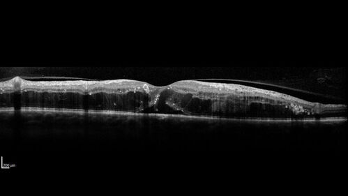 Siegrist Streaks and severe diabetic macular edema
56 year old female who presents four years after developing necrotizing fascitis and multiple organ failure from an infected foot from a roofing nail.  Her vision was 20/100 OU.  She has multiple peripheral pigment spots consistent with Siegrist streaks.
