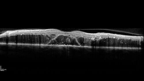Siegrist Streaks and severe diabetic macular edema
56 year old female who presents four years after developing necrotizing fascitis and multiple organ failure from an infected foot from a roofing nail.  Her vision was 20/100 OU.  She has multiple peripheral pigment spots consistent with Siegrist streaks.
