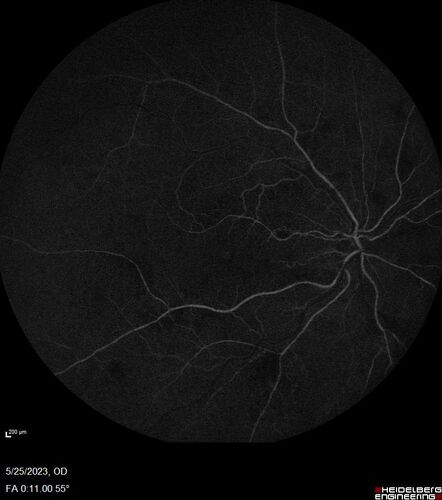 Siegrist Streaks and severe diabetic macular edema
56 year old female who presents four years after developing necrotizing fascitis and multiple organ failure from an infected foot from a roofing nail.  Her vision was 20/100 OU.  She has multiple peripheral pigment spots consistent with Siegrist streaks.
