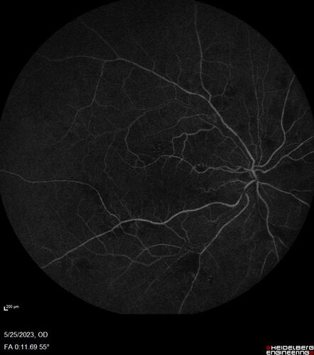 Siegrist Streaks and severe diabetic macular edema
56 year old female who presents four years after developing necrotizing fascitis and multiple organ failure from an infected foot from a roofing nail.  Her vision was 20/100 OU.  She has multiple peripheral pigment spots consistent with Siegrist streaks.
