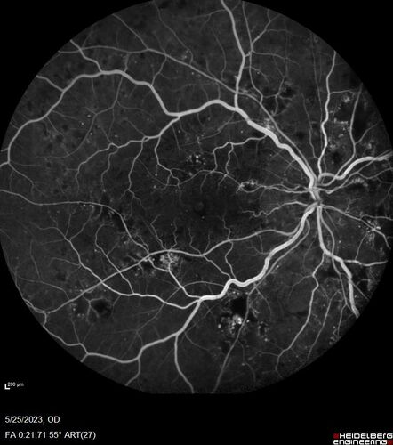 Siegrist Streaks and severe diabetic macular edema
56 year old female who presents four years after developing necrotizing fascitis and multiple organ failure from an infected foot from a roofing nail.  Her vision was 20/100 OU.  She has multiple peripheral pigment spots consistent with Siegrist streaks.
