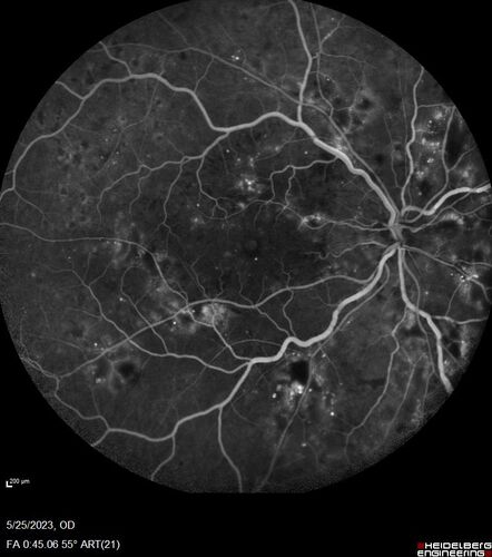 Siegrist Streaks and severe diabetic macular edema
56 year old female who presents four years after developing necrotizing fascitis and multiple organ failure from an infected foot from a roofing nail.  Her vision was 20/100 OU.  She has multiple peripheral pigment spots consistent with Siegrist streaks.
