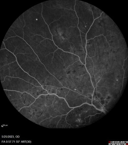 Siegrist Streaks and severe diabetic macular edema
56 year old female who presents four years after developing necrotizing fascitis and multiple organ failure from an infected foot from a roofing nail.  Her vision was 20/100 OU.  She has multiple peripheral pigment spots consistent with Siegrist streaks.
