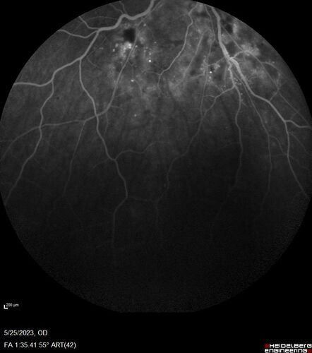 Siegrist Streaks and severe diabetic macular edema
56 year old female who presents four years after developing necrotizing fascitis and multiple organ failure from an infected foot from a roofing nail.  Her vision was 20/100 OU.  She has multiple peripheral pigment spots consistent with Siegrist streaks.
