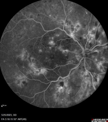 Siegrist Streaks and severe diabetic macular edema
56 year old female who presents four years after developing necrotizing fascitis and multiple organ failure from an infected foot from a roofing nail.  Her vision was 20/100 OU.  She has multiple peripheral pigment spots consistent with Siegrist streaks.
