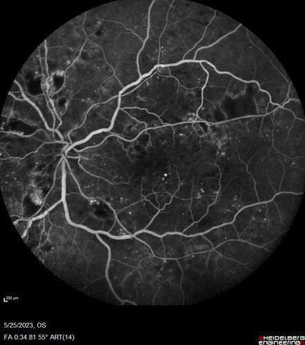 Siegrist Streaks and severe diabetic macular edema
56 year old female who presents four years after developing necrotizing fascitis and multiple organ failure from an infected foot from a roofing nail.  Her vision was 20/100 OU.  She has multiple peripheral pigment spots consistent with Siegrist streaks.
