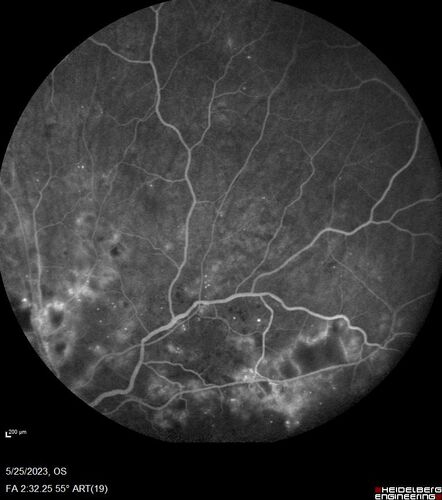Siegrist Streaks and severe diabetic macular edema
56 year old female who presents four years after developing necrotizing fascitis and multiple organ failure from an infected foot from a roofing nail.  Her vision was 20/100 OU.  She has multiple peripheral pigment spots consistent with Siegrist streaks.
