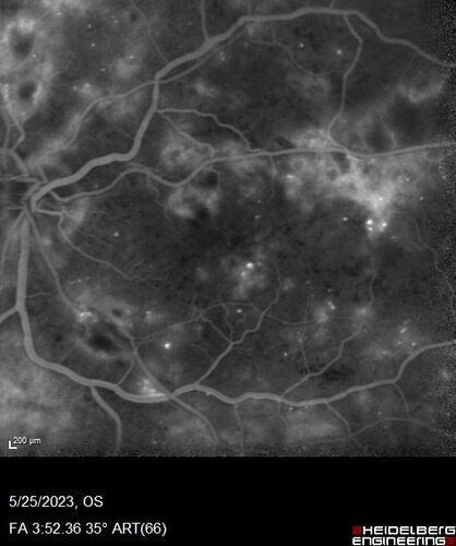 Siegrist Streaks and severe diabetic macular edema
56 year old female who presents four years after developing necrotizing fascitis and multiple organ failure from an infected foot from a roofing nail.  Her vision was 20/100 OU.  She has multiple peripheral pigment spots consistent with Siegrist streaks.
