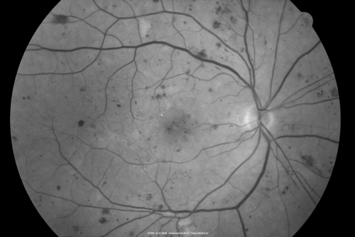 BDR and Diabetic Macular Edema with Fresh Laser Right Eye
60-year old man OD 20/60, OS 20/50 worsening vision both eyes
