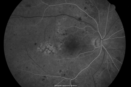 BDR and Diabetic Macular Edema with Fresh Laser Right Eye
60-year old man OD 20/60, OS 20/50 worsening vision both eyes
