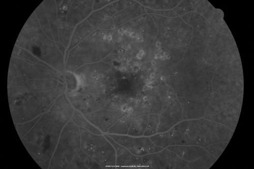 BDR and Diabetic Macular Edema with Fresh Laser Right Eye
60-year old man OD 20/60, OS 20/50 worsening vision both eyes
