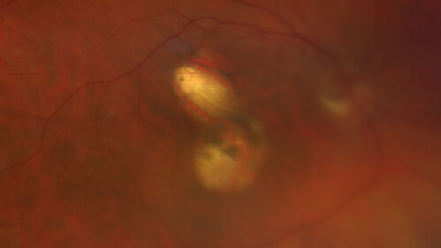 Dome Shaped Macula Left Eye
73 year old female Diagnosed with POHS in the past and treated with laser in the right eye in 1994 with vision loss.  She moved from Tampa to Largo in 2017 and started seeing Dr. Cohen.  She had her last injection in the left eye 2015 prior to moving to Largo.  She has been treated intermittently in the left eye and has been resistant to Anti-VEGF injections.  Her vision is good in the left eye. Images are from April 2023 one month following a Vabysmo injection in the left eye.
PMHx- thyroid disease
Meds: Synthroid
VA 20/200 OD, 20/25 OS
