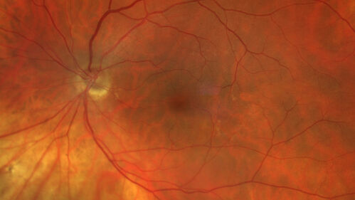 Dome Shaped Macula Left Eye
73 year old female Diagnosed with POHS in the past and treated with laser in the right eye in 1994 with vision loss.  She moved from Tampa to Largo in 2017 and started seeing Dr. Cohen.  She had her last injection in the left eye 2015 prior to moving to Largo.  She has been treated intermittently in the left eye and has been resistant to Anti-VEGF injections.  Her vision is good in the left eye. Images are from April 2023 one month following a Vabysmo injection in the left eye.
PMHx- thyroid disease
Meds: Synthroid
VA 20/200 OD, 20/25 OS
