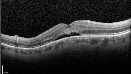 Dome Shaped Macula Left Eye
73 year old female Diagnosed with POHS in the past and treated with laser in the right eye in 1994 with vision loss.  She moved from Tampa to Largo in 2017 and started seeing Dr. Cohen.  She had her last injection in the left eye 2015 prior to moving to Largo.  She has been treated intermittently in the left eye and has been resistant to Anti-VEGF injections.  Her vision is good in the left eye. Images are from April 2023 one month following a Vabysmo injection in the left eye.
PMHx- thyroid disease
Meds: Synthroid
VA 20/200 OD, 20/25 OS
