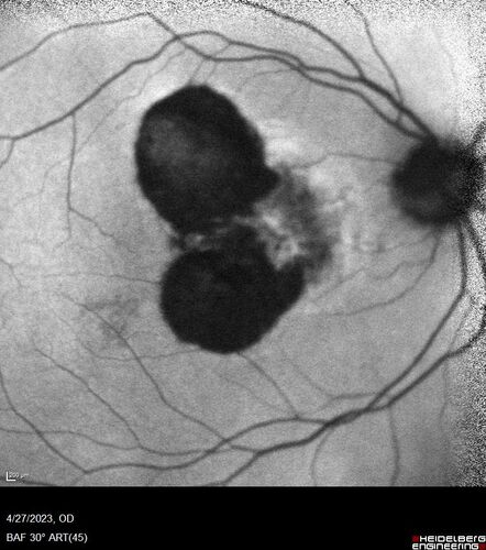 Dome Shaped Macula Left Eye
73 year old female Diagnosed with POHS in the past and treated with laser in the right eye in 1994 with vision loss.  She moved from Tampa to Largo in 2017 and started seeing Dr. Cohen.  She had her last injection in the left eye 2015 prior to moving to Largo.  She has been treated intermittently in the left eye and has been resistant to Anti-VEGF injections.  Her vision is good in the left eye. Images are from April 2023 one month following a Vabysmo injection in the left eye.
PMHx- thyroid disease
Meds: Synthroid
VA 20/200 OD, 20/25 OS
