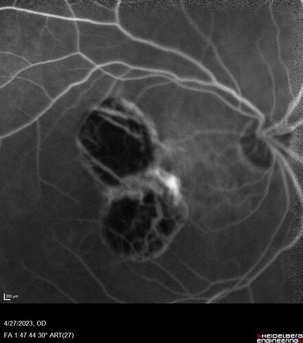 Dome Shaped Macula Left Eye
73 year old female Diagnosed with POHS in the past and treated with laser in the right eye in 1994 with vision loss.  She moved from Tampa to Largo in 2017 and started seeing Dr. Cohen.  She had her last injection in the left eye 2015 prior to moving to Largo.  She has been treated intermittently in the left eye and has been resistant to Anti-VEGF injections.  Her vision is good in the left eye. Images are from April 2023 one month following a Vabysmo injection in the left eye.
PMHx- thyroid disease
Meds: Synthroid
VA 20/200 OD, 20/25 OS

