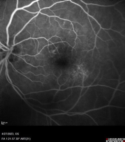 Dome Shaped Macula Left Eye
73 year old female Diagnosed with POHS in the past and treated with laser in the right eye in 1994 with vision loss.  She moved from Tampa to Largo in 2017 and started seeing Dr. Cohen.  She had her last injection in the left eye 2015 prior to moving to Largo.  She has been treated intermittently in the left eye and has been resistant to Anti-VEGF injections.  Her vision is good in the left eye. Images are from April 2023 one month following a Vabysmo injection in the left eye.
PMHx- thyroid disease
Meds: Synthroid
VA 20/200 OD, 20/25 OS
