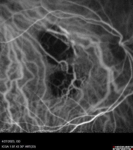 Dome Shaped Macula Left Eye
73 year old female Diagnosed with POHS in the past and treated with laser in the right eye in 1994 with vision loss.  She moved from Tampa to Largo in 2017 and started seeing Dr. Cohen.  She had her last injection in the left eye 2015 prior to moving to Largo.  She has been treated intermittently in the left eye and has been resistant to Anti-VEGF injections.  Her vision is good in the left eye. Images are from April 2023 one month following a Vabysmo injection in the left eye.
PMHx- thyroid disease
Meds: Synthroid
VA 20/200 OD, 20/25 OS
