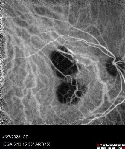 Dome Shaped Macula Left Eye
73 year old female Diagnosed with POHS in the past and treated with laser in the right eye in 1994 with vision loss.  She moved from Tampa to Largo in 2017 and started seeing Dr. Cohen.  She had her last injection in the left eye 2015 prior to moving to Largo.  She has been treated intermittently in the left eye and has been resistant to Anti-VEGF injections.  Her vision is good in the left eye. Images are from April 2023 one month following a Vabysmo injection in the left eye.
PMHx- thyroid disease
Meds: Synthroid
VA 20/200 OD, 20/25 OS
