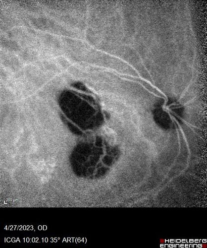 Dome Shaped Macula Left Eye
73 year old female Diagnosed with POHS in the past and treated with laser in the right eye in 1994 with vision loss.  She moved from Tampa to Largo in 2017 and started seeing Dr. Cohen.  She had her last injection in the left eye 2015 prior to moving to Largo.  She has been treated intermittently in the left eye and has been resistant to Anti-VEGF injections.  Her vision is good in the left eye. Images are from April 2023 one month following a Vabysmo injection in the left eye.
PMHx- thyroid disease
Meds: Synthroid
VA 20/200 OD, 20/25 OS
